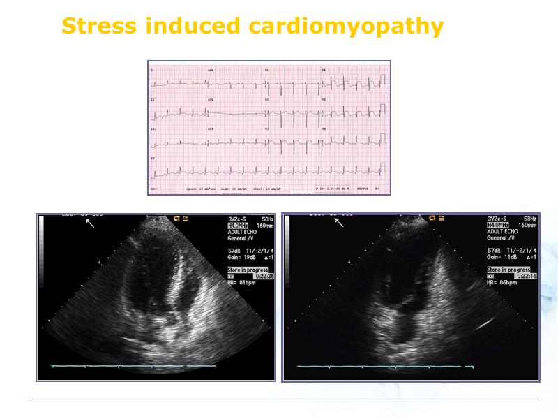 Stress induced cardiomyopathy